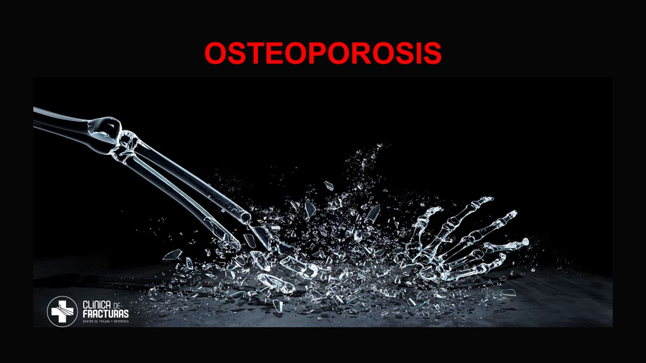 OSTEOPOROSIS